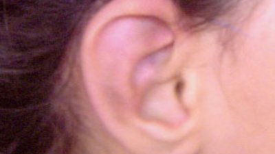 Korekcija ušnih školjki