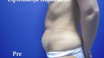 Liposuction of the abdominal and waist region